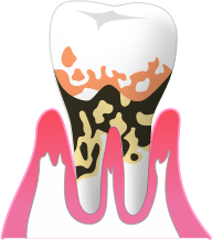 P4:重度歯周炎
